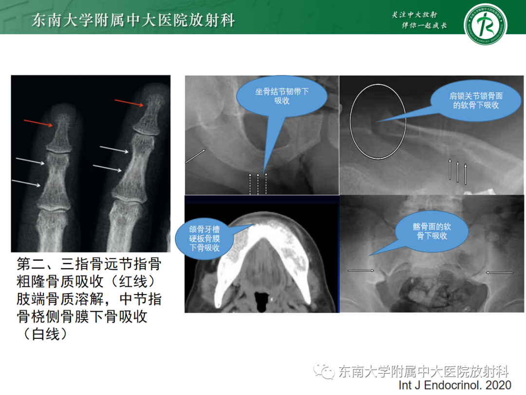 【PPT】原发性甲状旁腺功能亢进-22