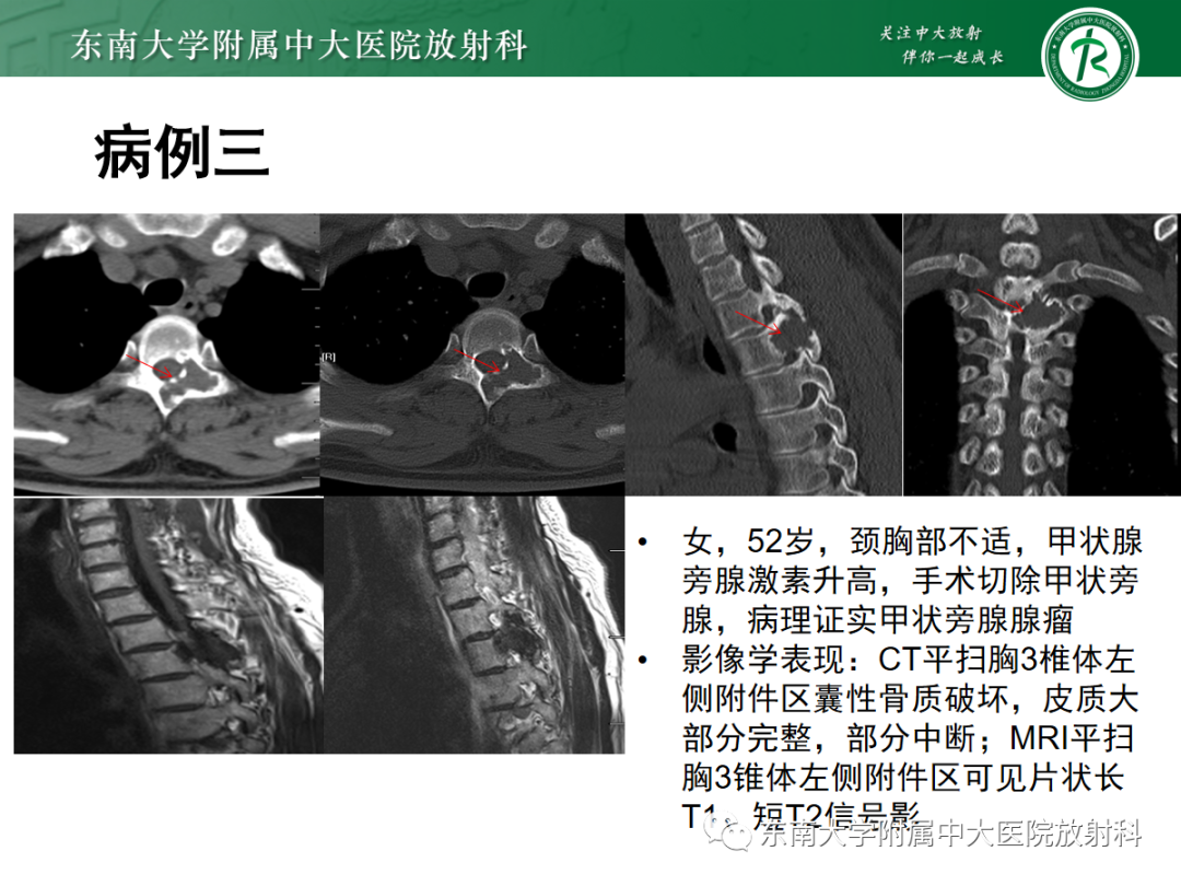 【PPT】原发性甲状旁腺功能亢进-24