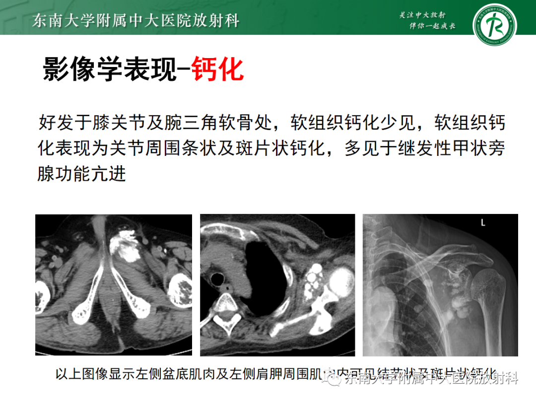 【PPT】原发性甲状旁腺功能亢进-26