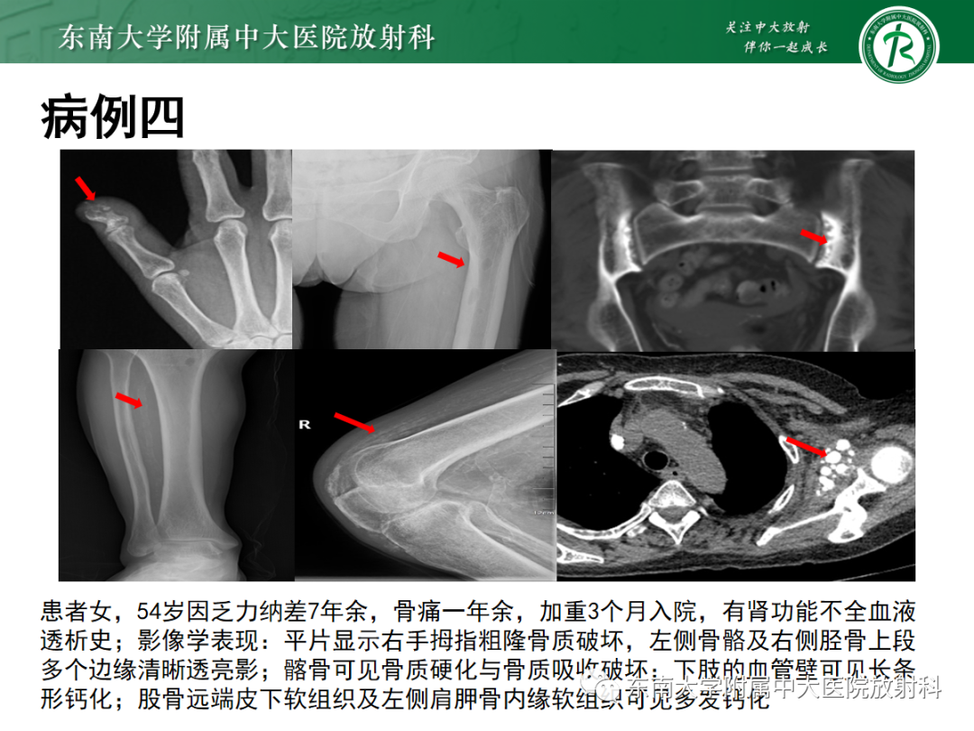 【PPT】原发性甲状旁腺功能亢进-29