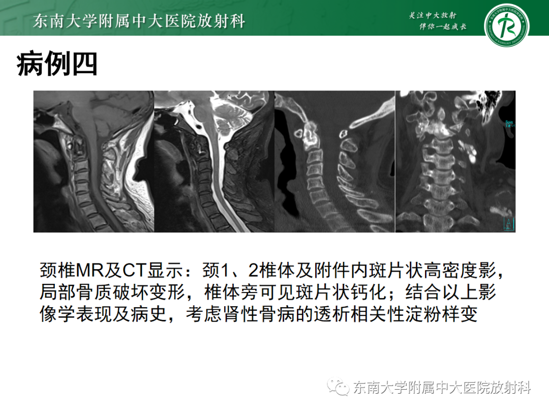 【PPT】原发性甲状旁腺功能亢进-30