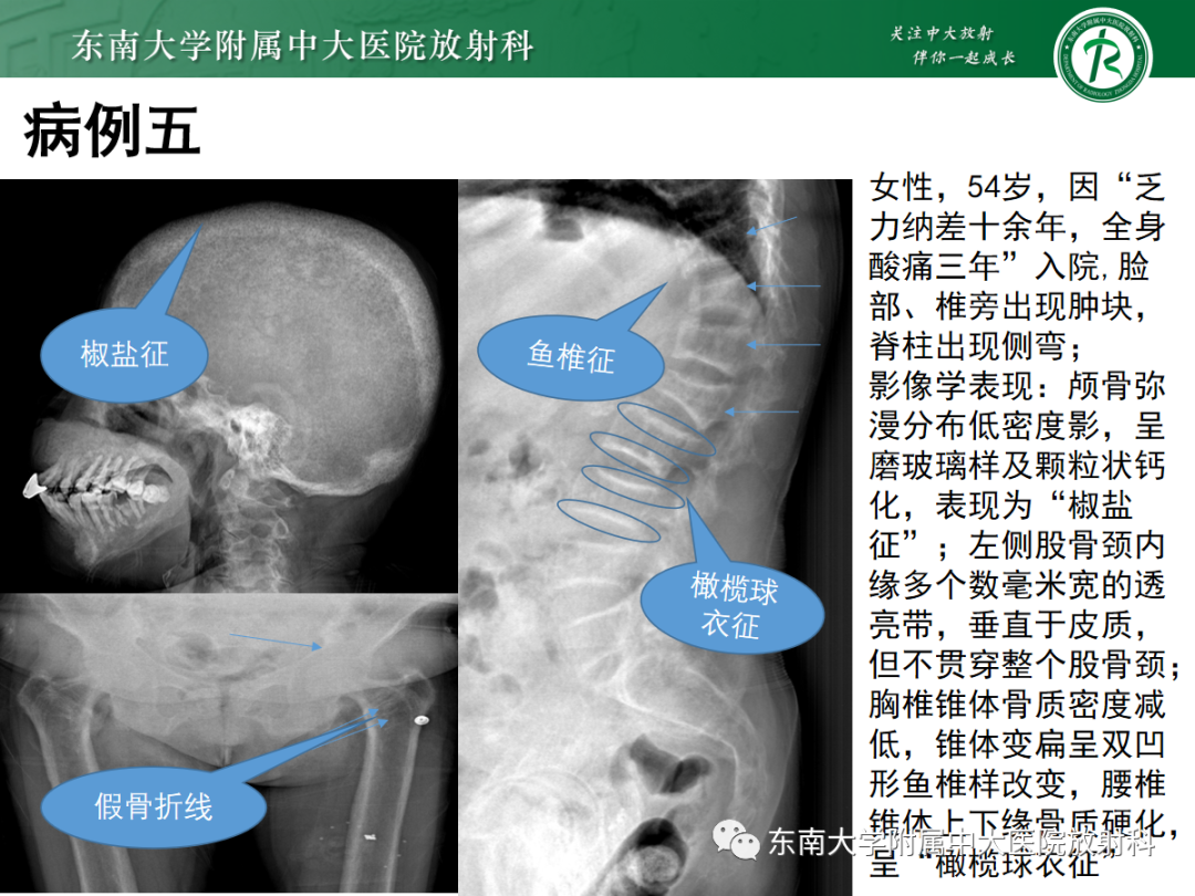 【PPT】原发性甲状旁腺功能亢进-31