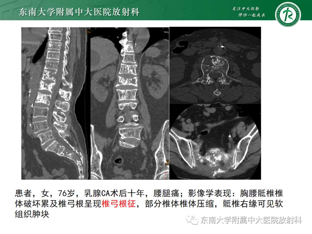 【PPT】原发性甲状旁腺功能亢进-35