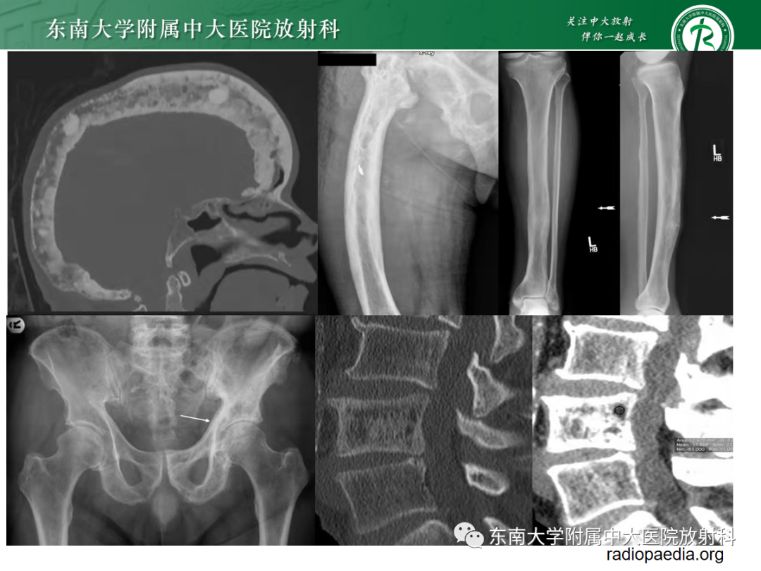 【PPT】原发性甲状旁腺功能亢进-37