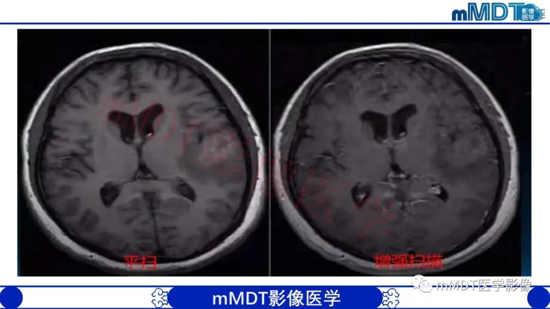 【PPT】系统性红斑狼疮脑病-3