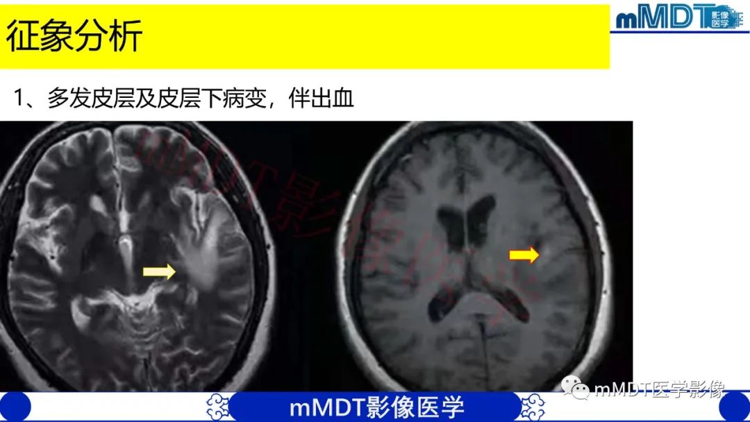 【PPT】系统性红斑狼疮脑病-4