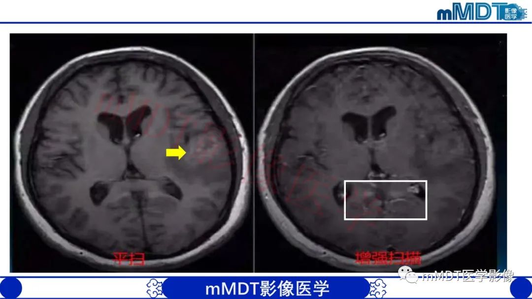 【PPT】系统性红斑狼疮脑病-5