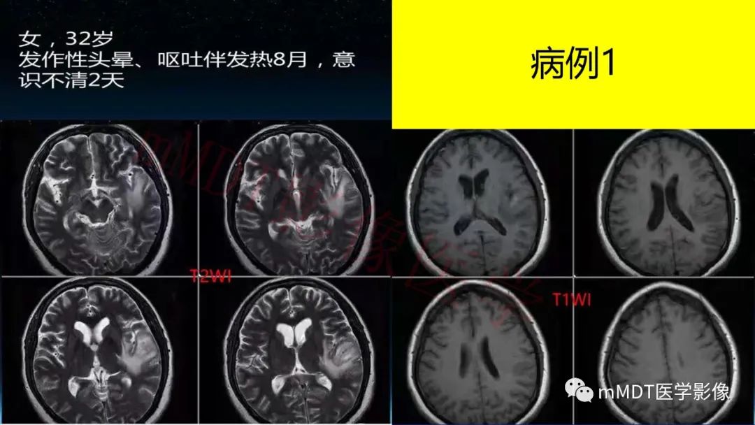 【PPT】系统性红斑狼疮脑病-2