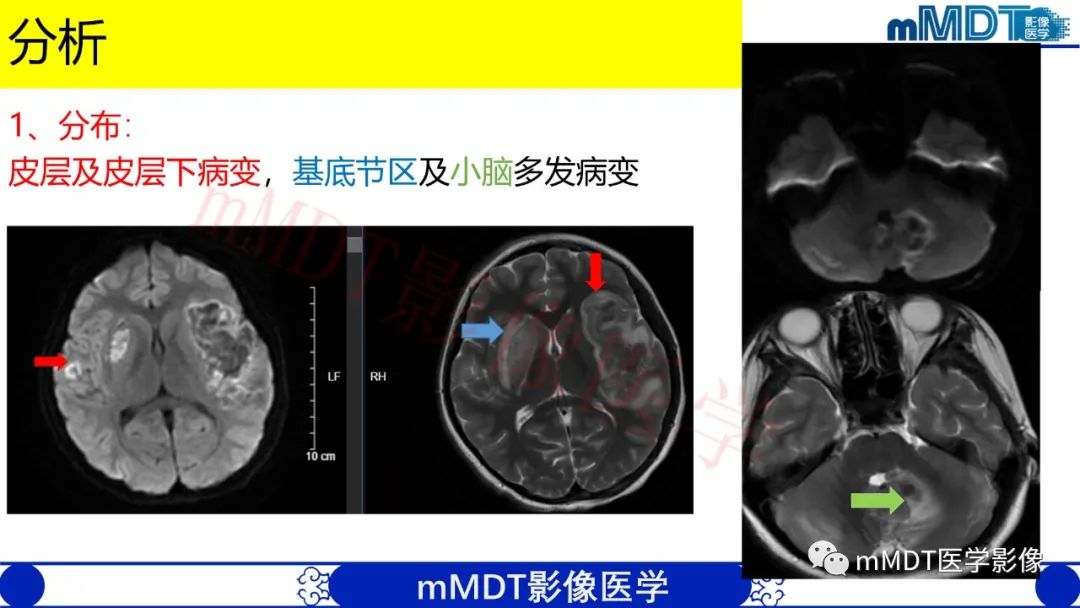 【PPT】系统性红斑狼疮脑病-17