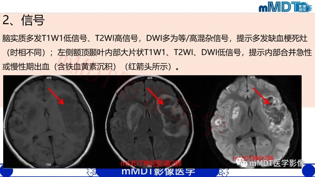 【PPT】系统性红斑狼疮脑病-18