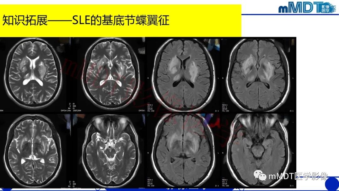 【PPT】系统性红斑狼疮脑病-21