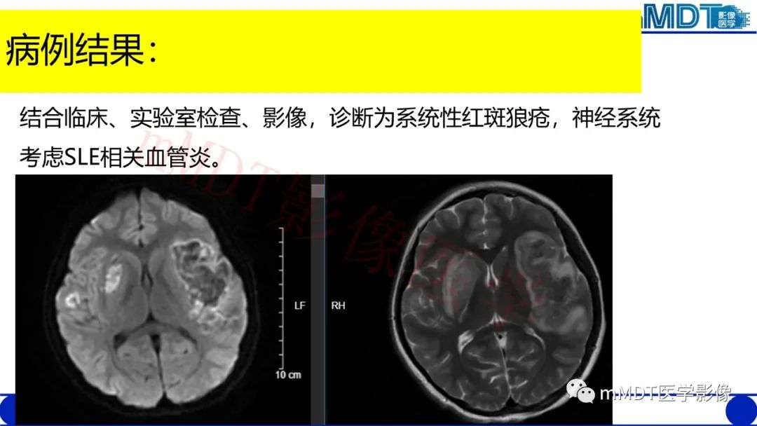 【PPT】系统性红斑狼疮脑病-23