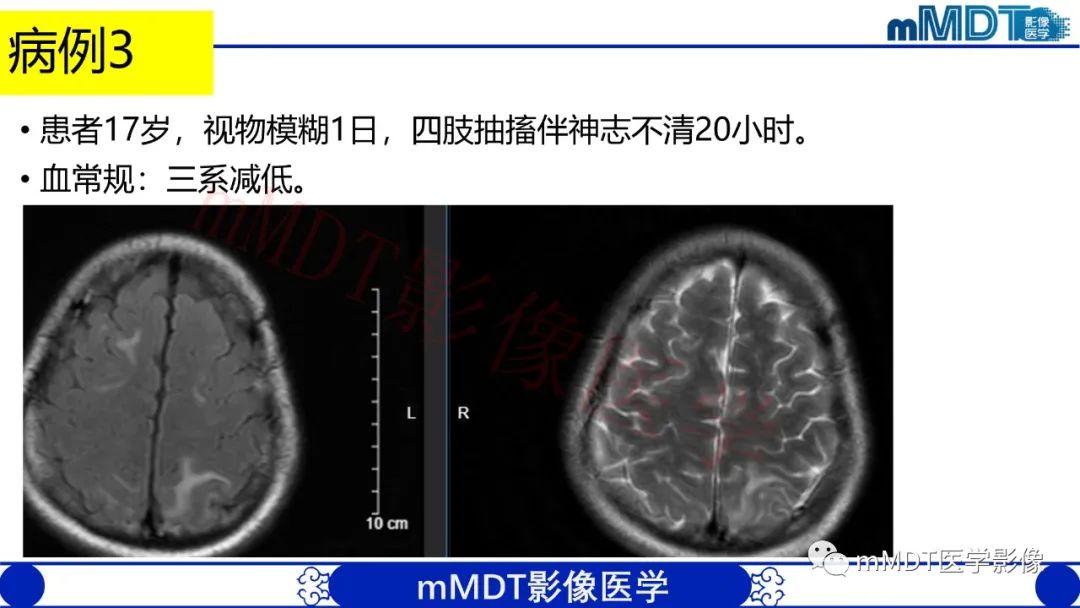 【PPT】系统性红斑狼疮脑病-24