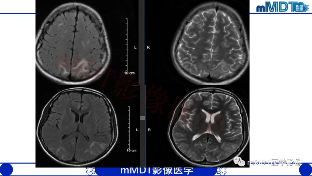 【PPT】系统性红斑狼疮脑病-25