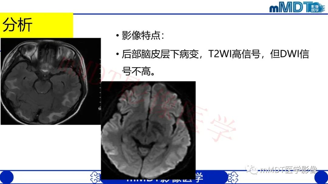 【PPT】系统性红斑狼疮脑病-27