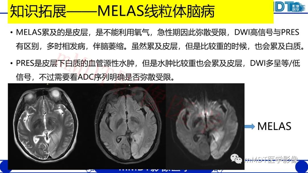 【PPT】系统性红斑狼疮脑病-29
