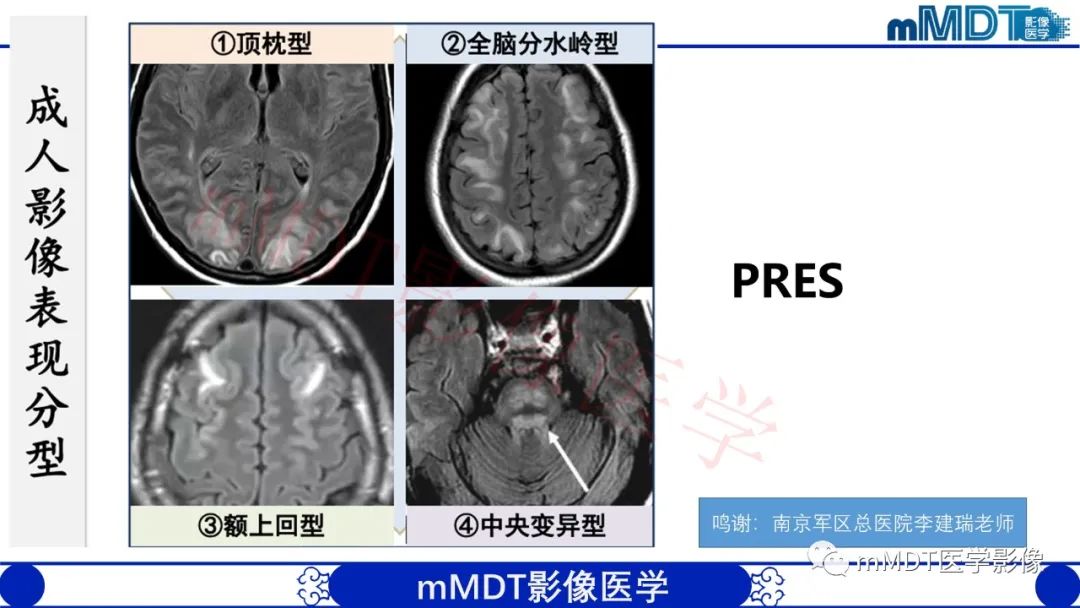 【PPT】系统性红斑狼疮脑病-32