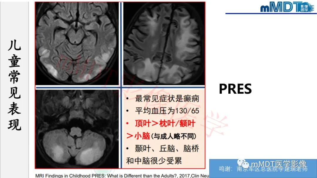 【PPT】系统性红斑狼疮脑病-33