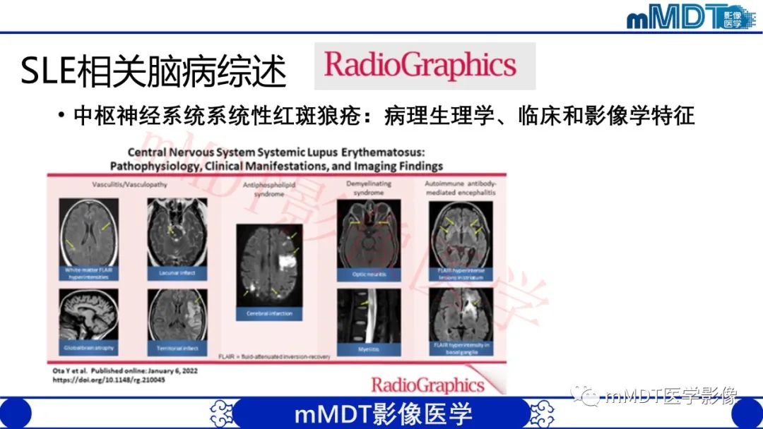 【PPT】系统性红斑狼疮脑病-36