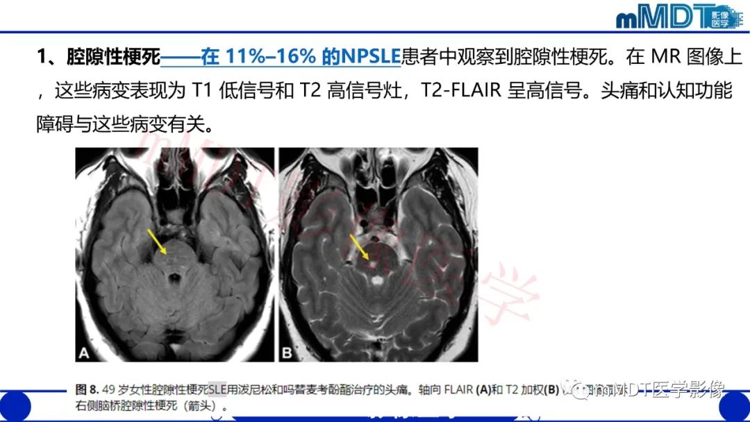 【PPT】系统性红斑狼疮脑病-39