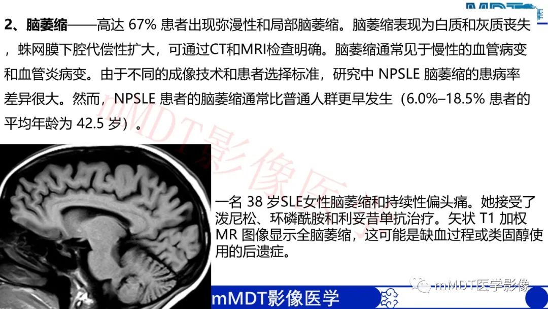 【PPT】系统性红斑狼疮脑病-40