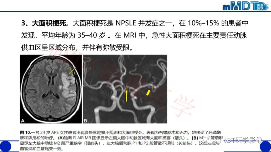 【PPT】系统性红斑狼疮脑病-41