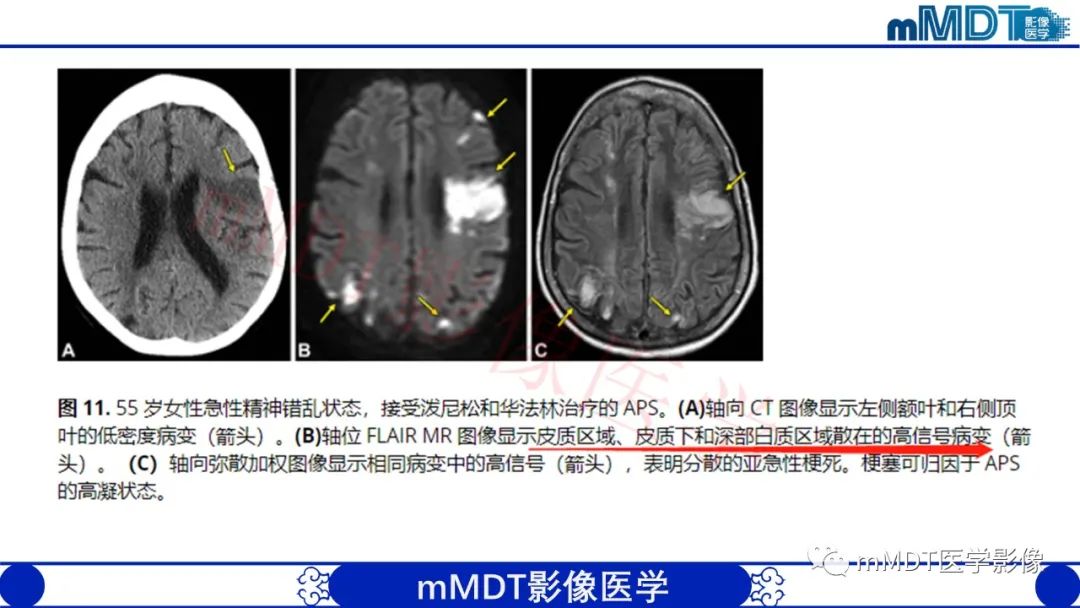 【PPT】系统性红斑狼疮脑病-44