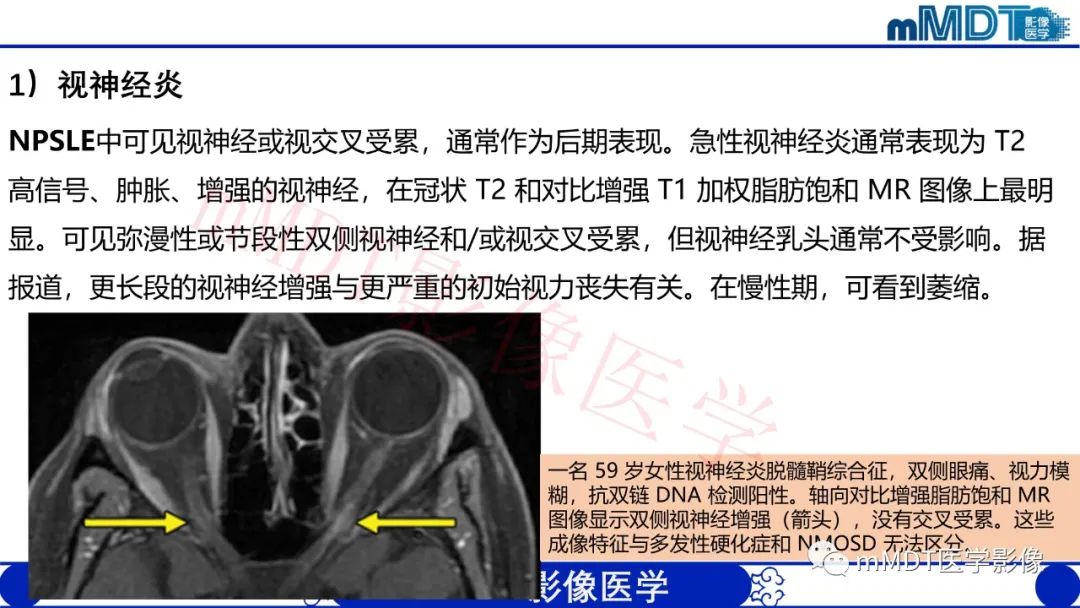 【PPT】系统性红斑狼疮脑病-46