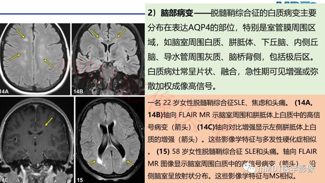 【PPT】系统性红斑狼疮脑病-47