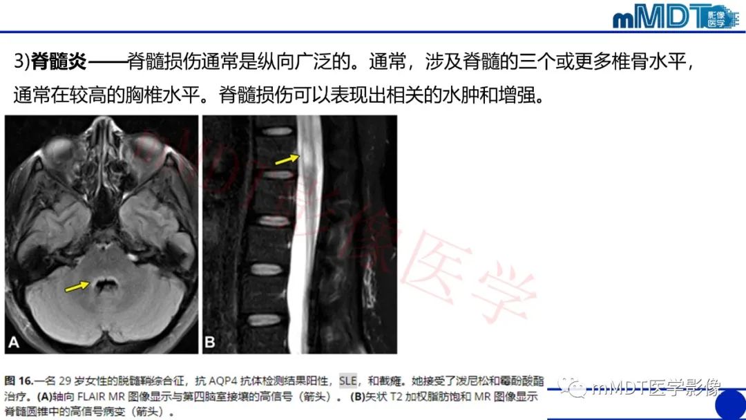 【PPT】系统性红斑狼疮脑病-48