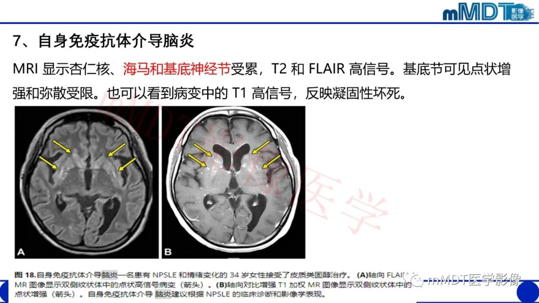 【PPT】系统性红斑狼疮脑病-49