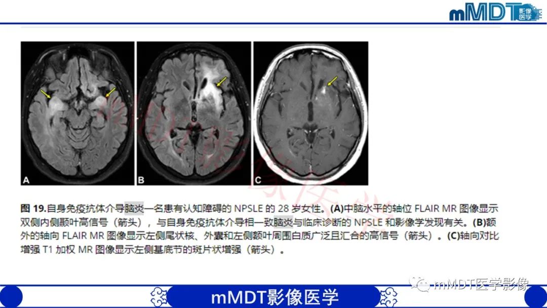 【PPT】系统性红斑狼疮脑病-50