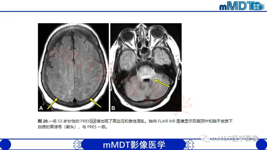 【PPT】系统性红斑狼疮脑病-52