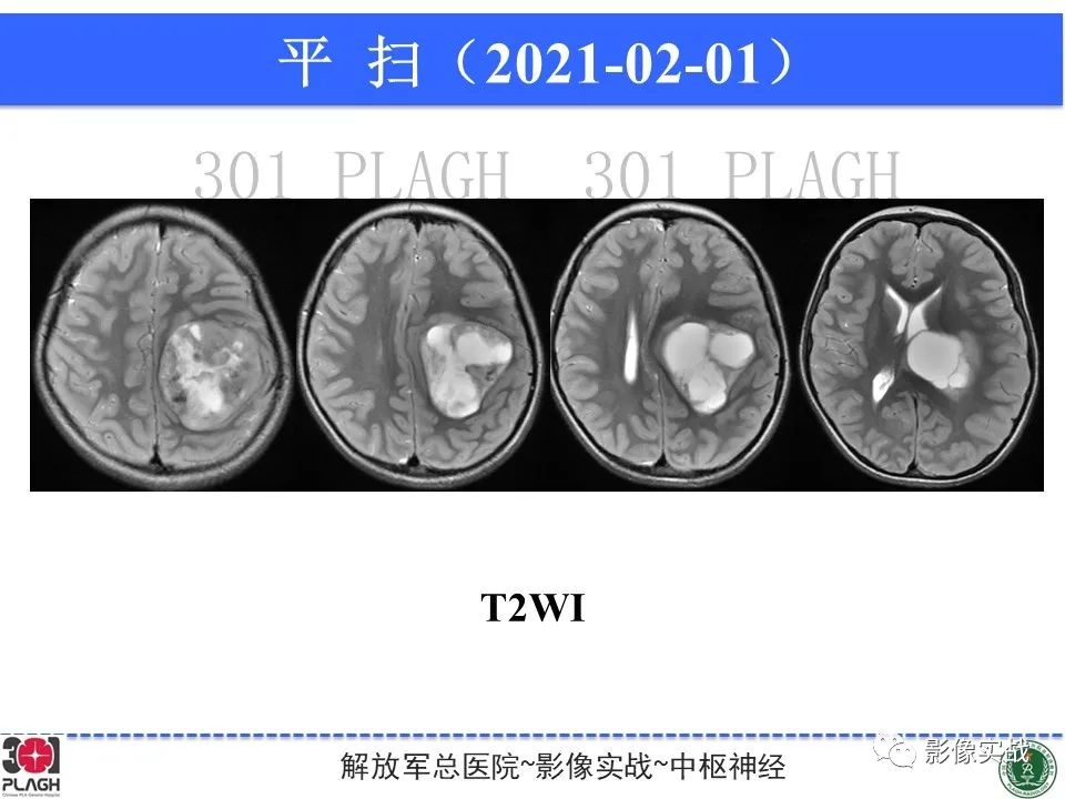 【病例】幕上室管膜瘤1例MR影像-5