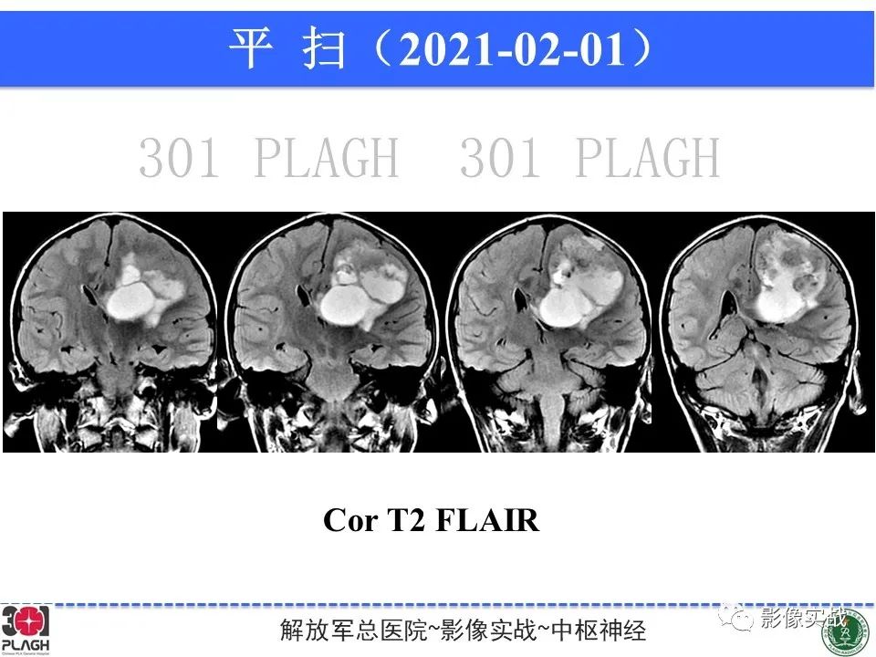 【病例】幕上室管膜瘤1例MR影像-9