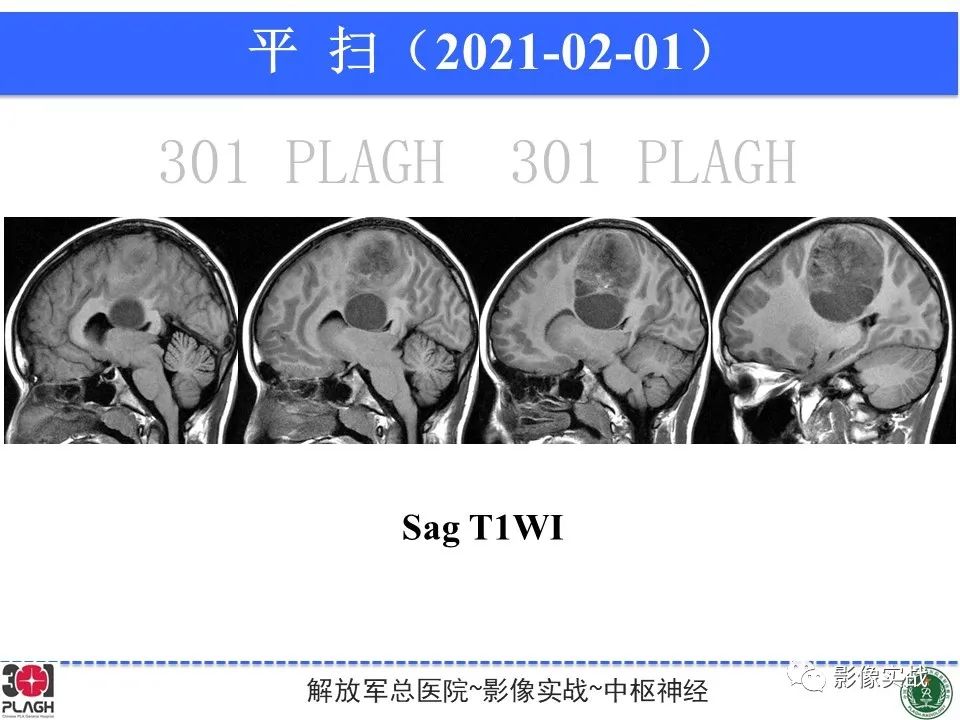 【病例】幕上室管膜瘤1例MR影像-10