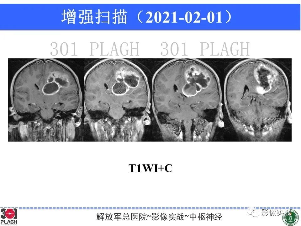 【病例】幕上室管膜瘤1例MR影像-12