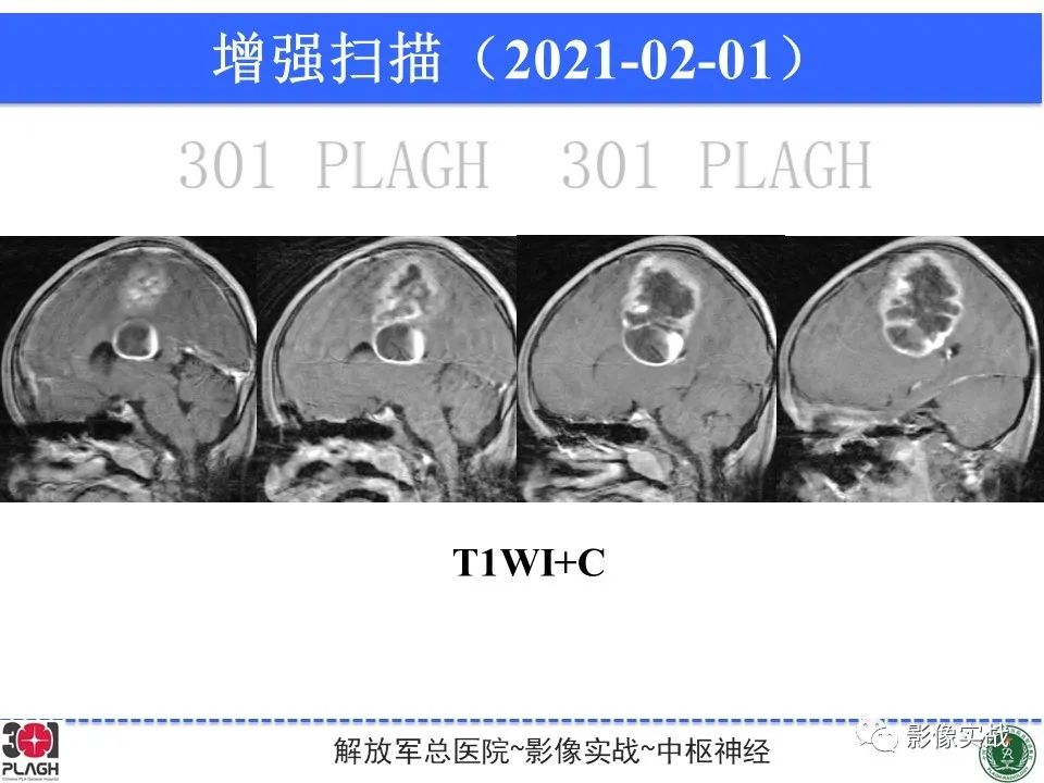 【病例】幕上室管膜瘤1例MR影像-13