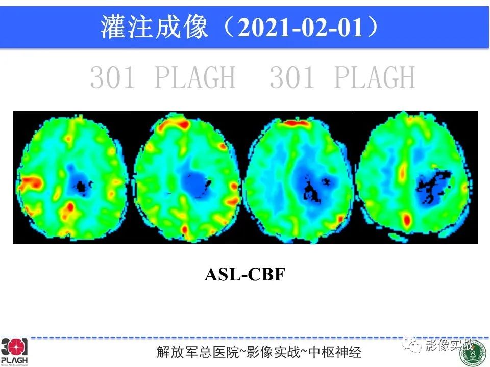 【病例】幕上室管膜瘤1例MR影像-14