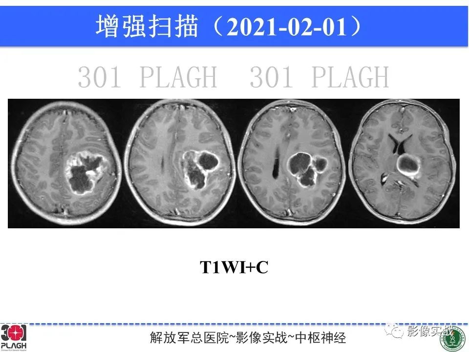 【病例】幕上室管膜瘤1例MR影像-11