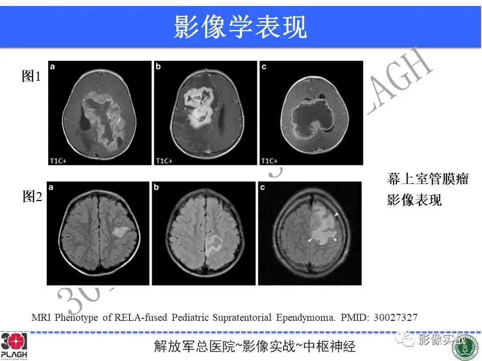 【病例】幕上室管膜瘤1例MR影像-31