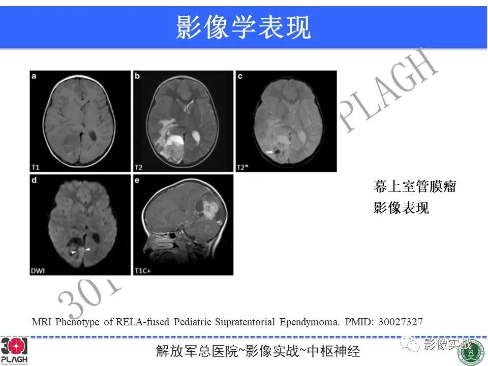【病例】幕上室管膜瘤1例MR影像-29