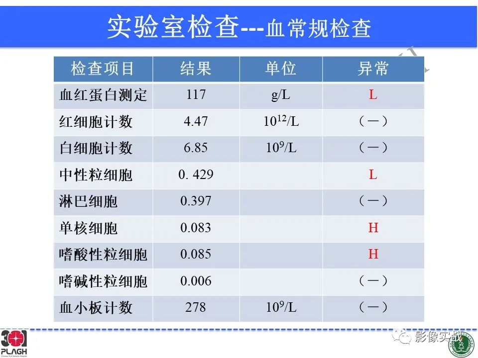 【病例】幕上室管膜瘤1例MR影像-4