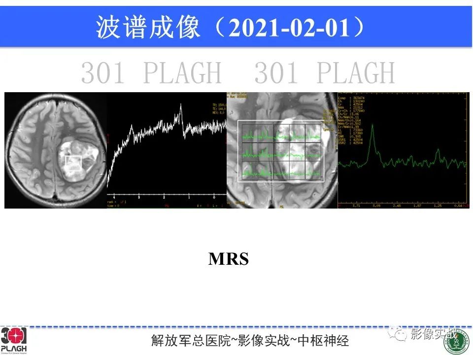 【病例】幕上室管膜瘤1例MR影像-15