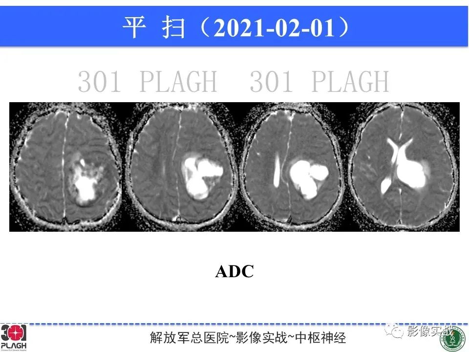 【病例】幕上室管膜瘤1例MR影像-8