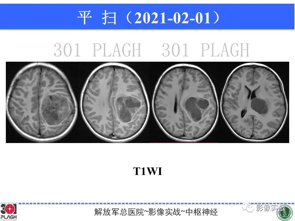 【病例】幕上室管膜瘤1例MR影像-6