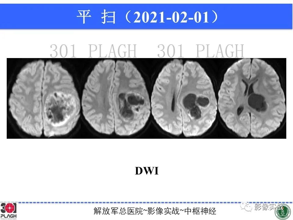 【病例】幕上室管膜瘤1例MR影像-7