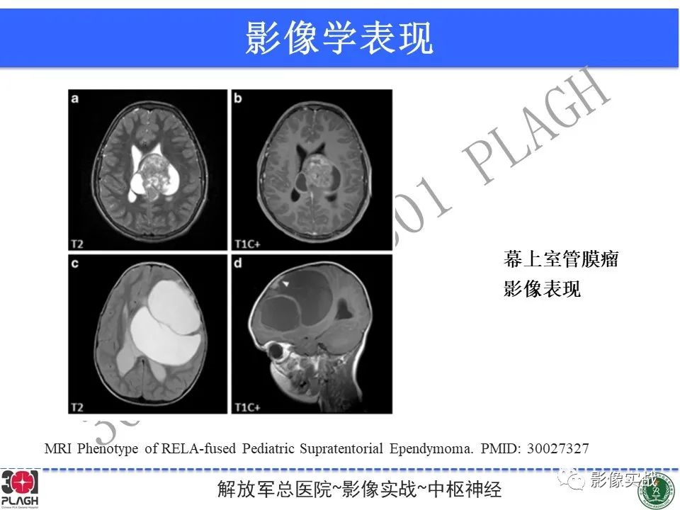 【病例】幕上室管膜瘤1例MR影像-30