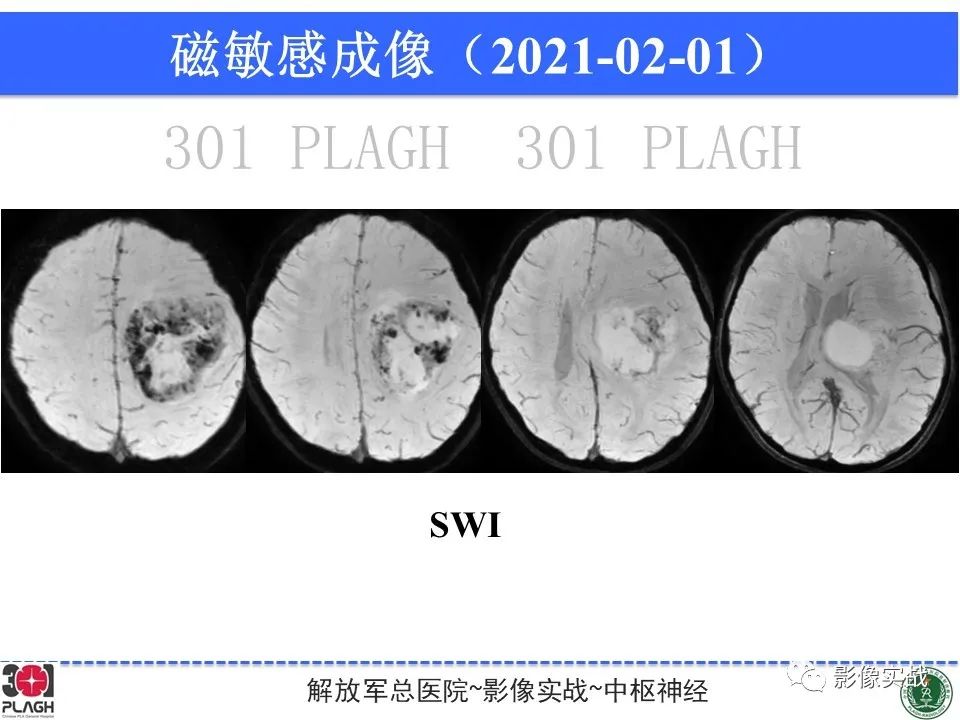 【病例】幕上室管膜瘤1例MR影像-16