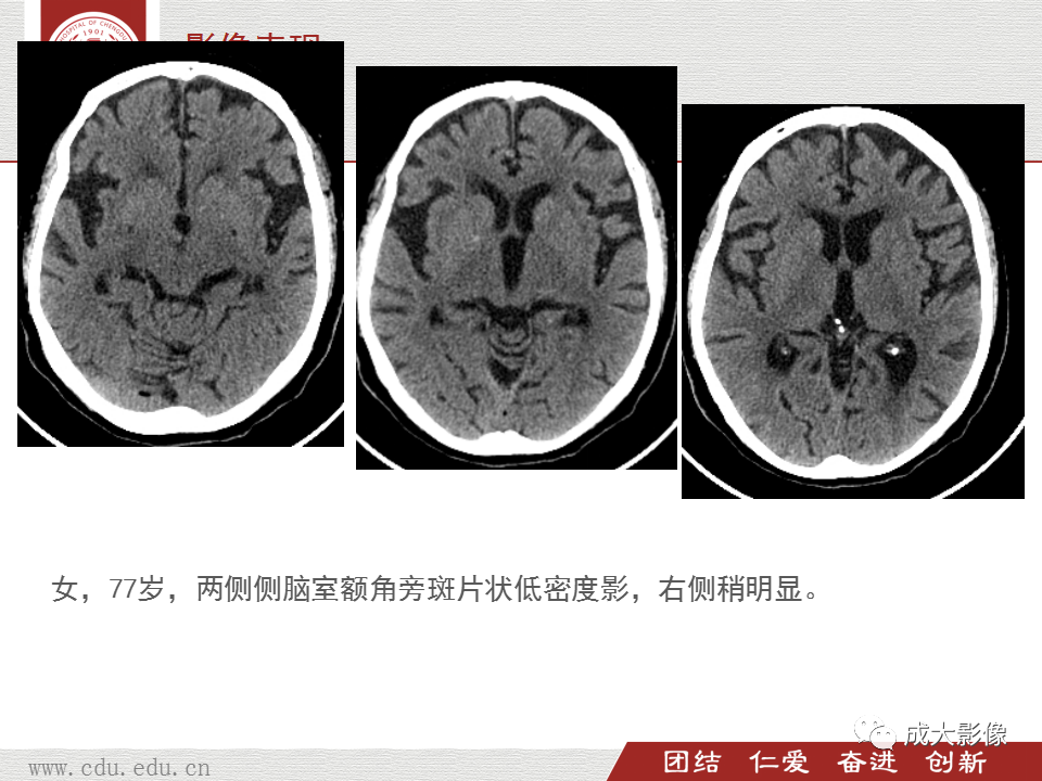 【PPT】脑白质疏松症-9